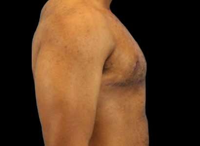 Female To Male Breast Before & After Patient #3998
