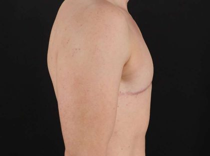 Female To Male Breast Before & After Patient #4009