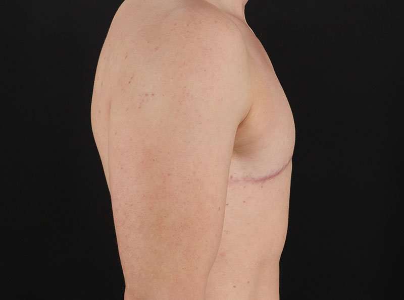 Female To Male Breast Before & After Patient #4009