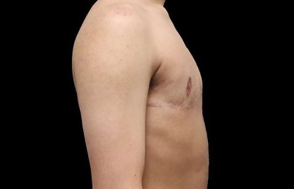 Female To Male Breast Before & After Patient #4020