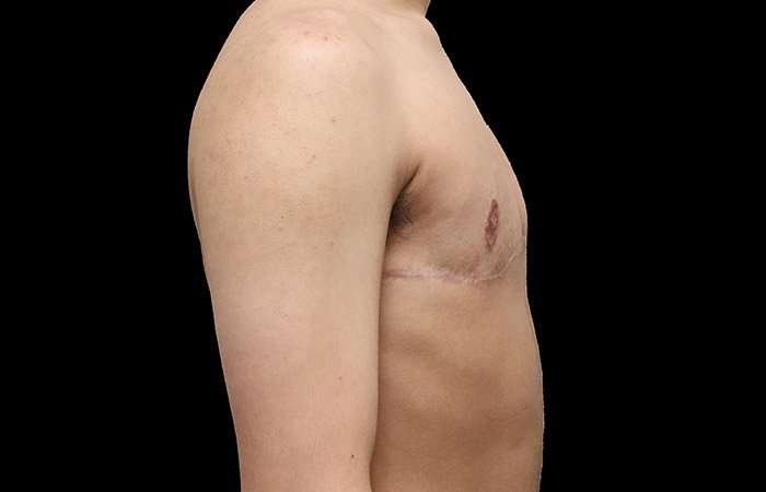 Female To Male Breast Before & After Patient #4020