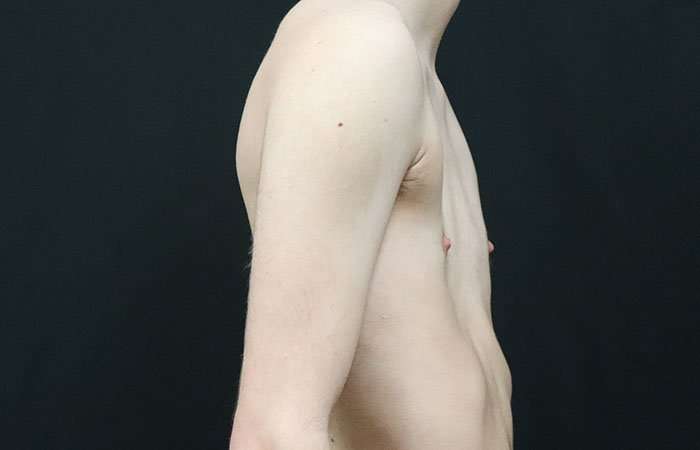 Female To Male Breast Before & After Patient #4031