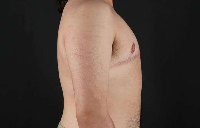 Female To Male Breast Before & After Patient #4042