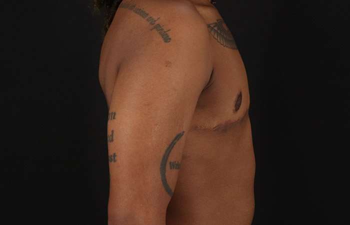 Female To Male Breast Before & After Patient #4053