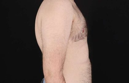 Female To Male Breast Before & After Patient #4075