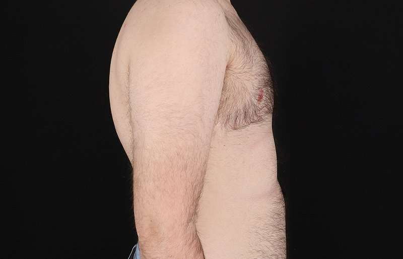 Female To Male Breast Before & After Patient #4075