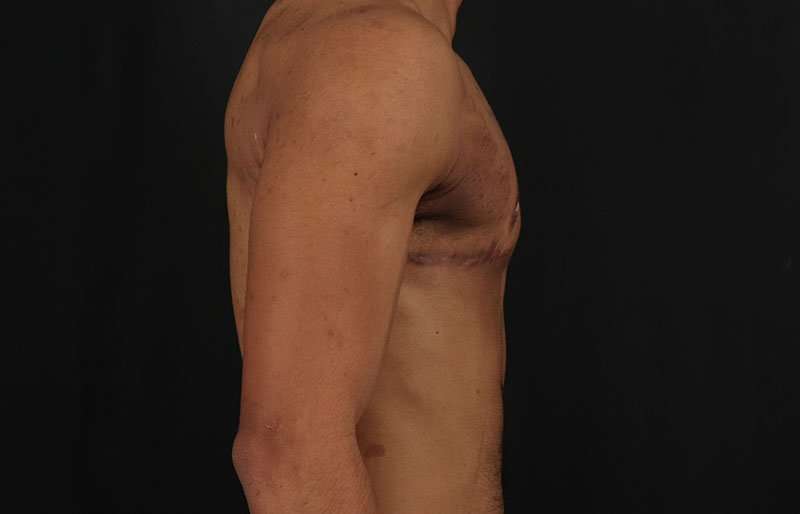 Female To Male Breast Before & After Patient #4086