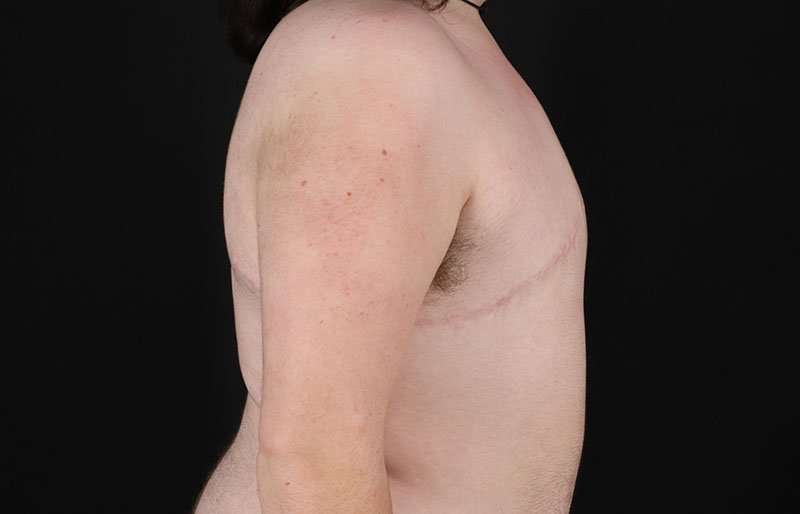 Female To Male Breast Before & After Patient #4097