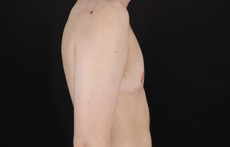 Female To Male Breast Before & After Patient #4108