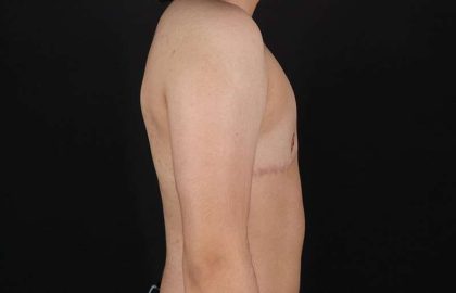 Female To Male Breast Before & After Patient #4119