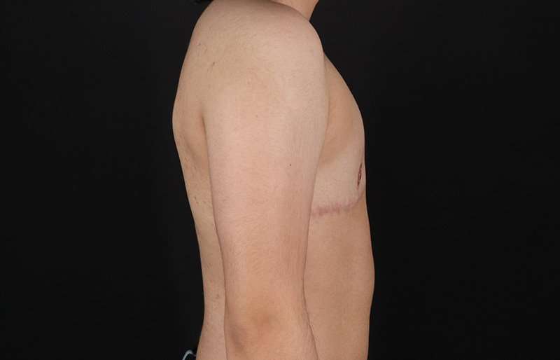 Female To Male Breast Before & After Patient #4119