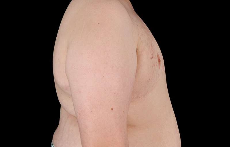 Female To Male Breast Before & After Patient #4130