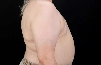 Female To Male Breast Before & After Patient #4141