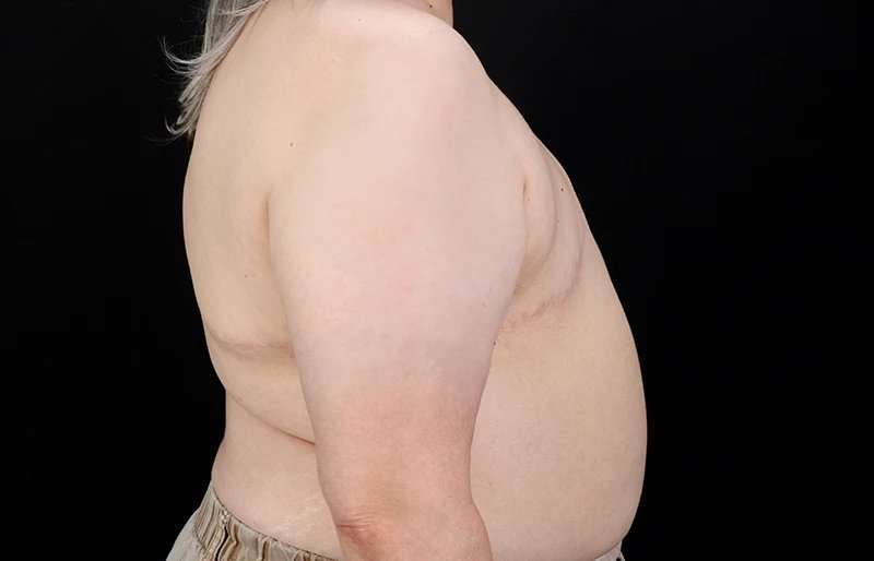 Female To Male Breast Before & After Patient #4141