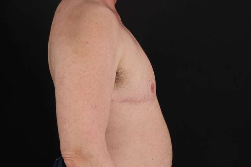 Female To Male Breast Before & After Patient #4152