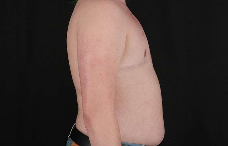 Female To Male Breast Before & After Patient #4163