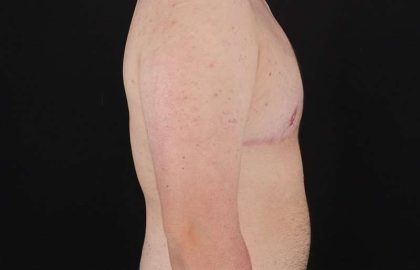 Female To Male Breast Before & After Patient #4174