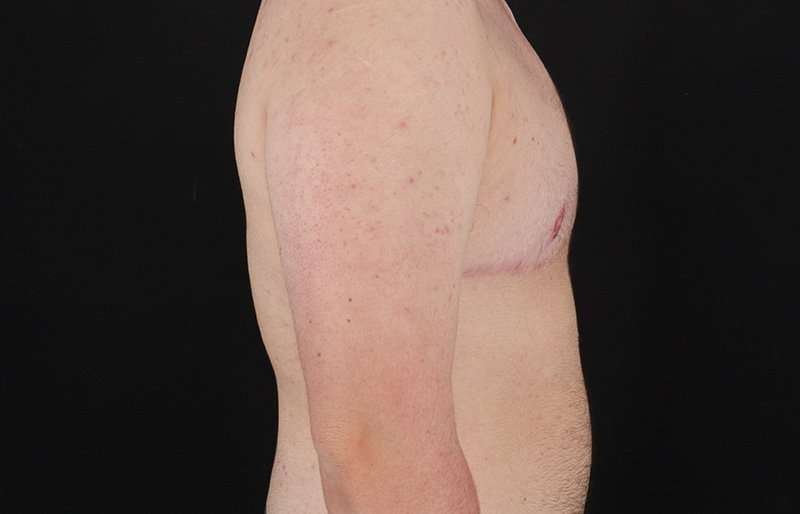 Female To Male Breast Before & After Patient #4174