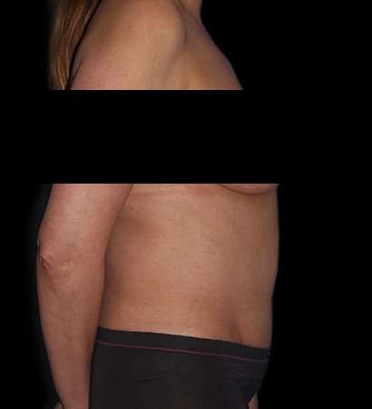 Abdominoplasty (Tummy Tuck) Before & After Patient #590