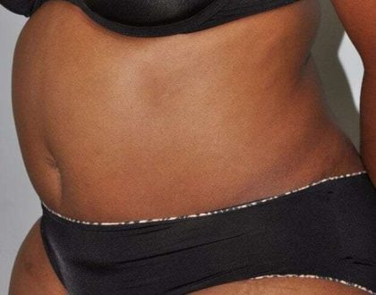 Abdominoplasty (Tummy Tuck) Before & After Patient #913