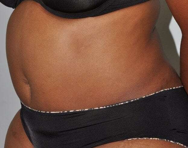 Abdominoplasty (Tummy Tuck) Before & After Patient #913
