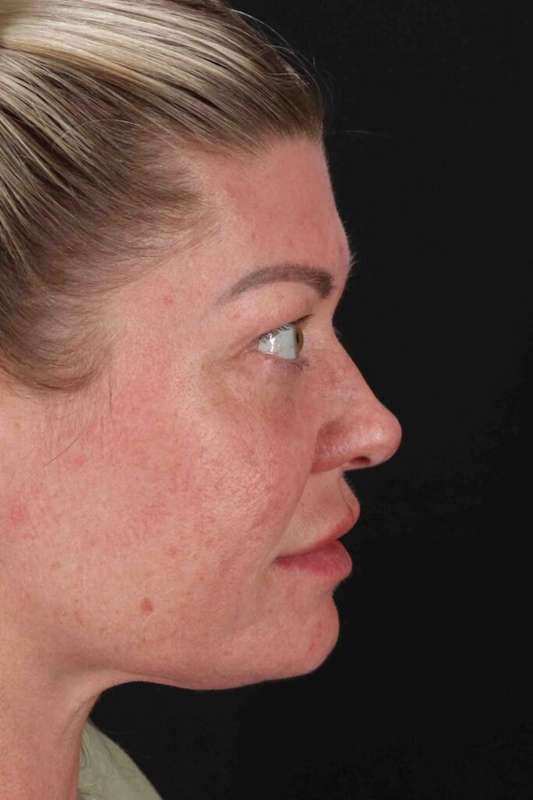 Fat Grafting To The Face Before & After Patient #4232