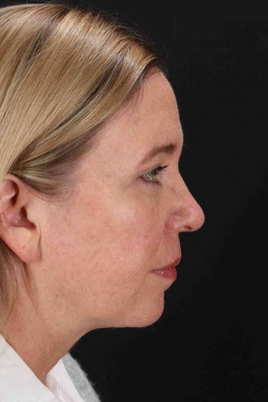 Fat Grafting To The Face Before & After Patient #4243