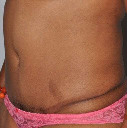 Abdominoplasty (Tummy Tuck) Before & After Patient #920