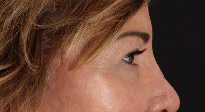 Blepharoplasty (Eyelid Surgery) Before & After Patient #4316