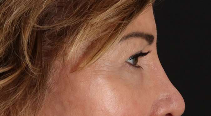 Blepharoplasty (Eyelid Surgery) Before & After Patient #4316
