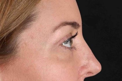 Blepharoplasty (Eyelid Surgery) Before & After Patient #4338