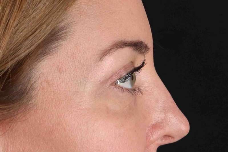 Blepharoplasty (Eyelid Surgery) Before & After Patient #4338