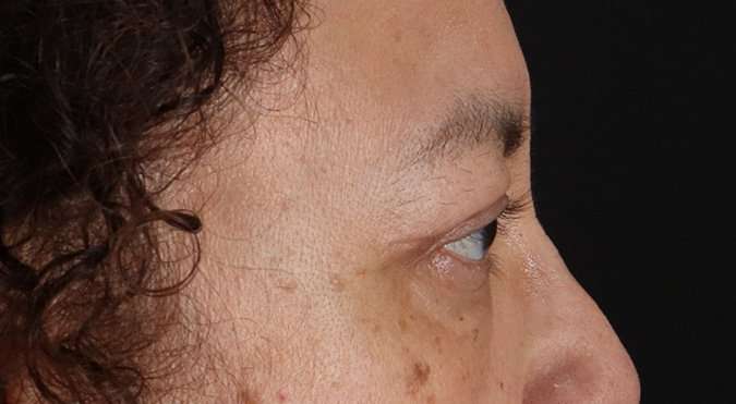 Blepharoplasty (Eyelid Surgery) Before & After Patient #4349
