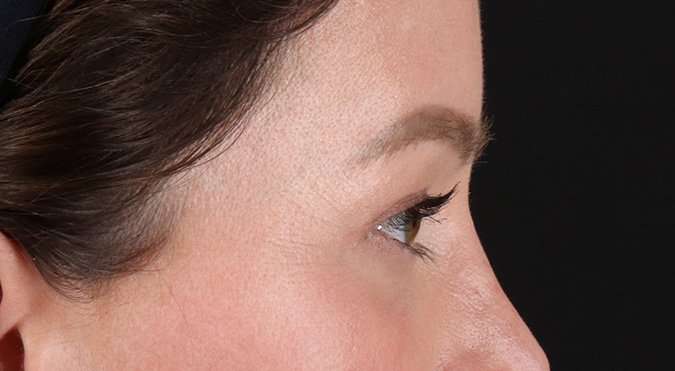 Blepharoplasty (Eyelid Surgery) Before & After Patient #4360