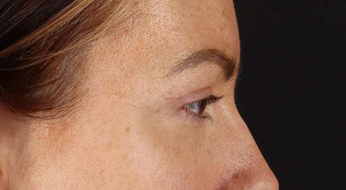 Blepharoplasty (Eyelid Surgery) Before & After Patient #4371