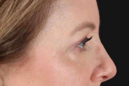 Blepharoplasty (Eyelid Surgery) Before & After Patient #4382