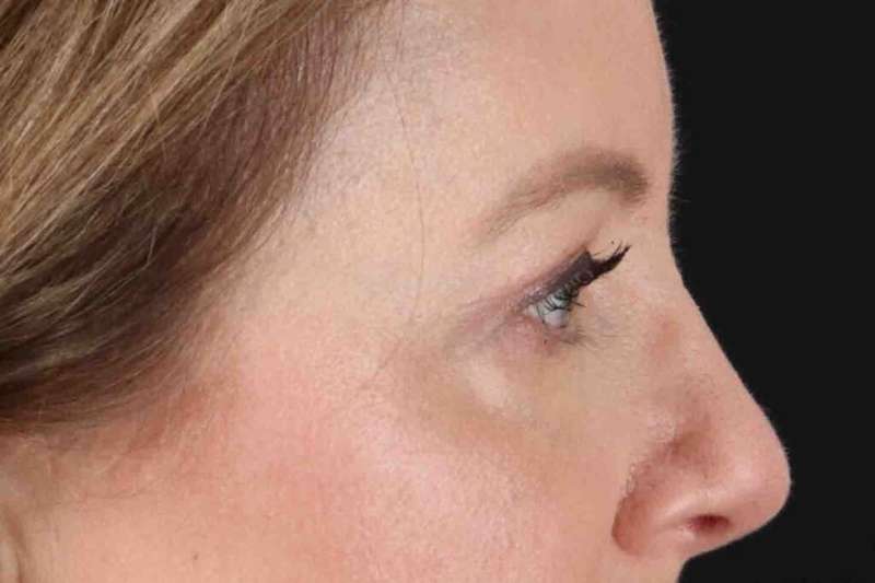 Blepharoplasty (Eyelid Surgery) Before & After Patient #4382
