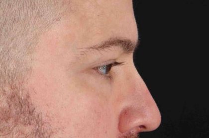 Blepharoplasty (Eyelid Surgery) Before & After Patient #4393
