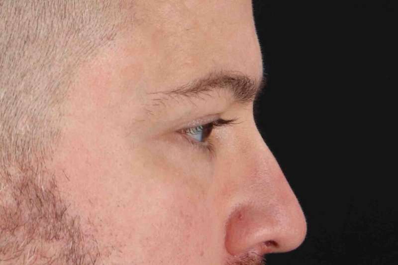 Blepharoplasty (Eyelid Surgery) Before & After Patient #4393