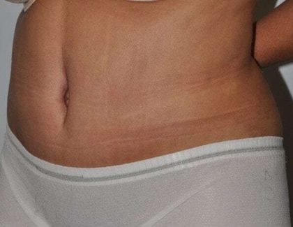 Abdominoplasty (Tummy Tuck) Before & After Patient #928
