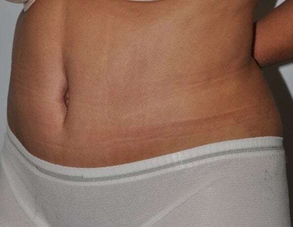 Abdominoplasty (Tummy Tuck) Before & After Patient #928