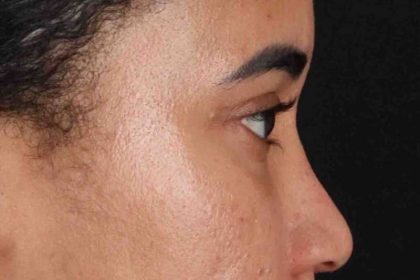 Blepharoplasty (Eyelid Surgery) Before & After Patient #4404