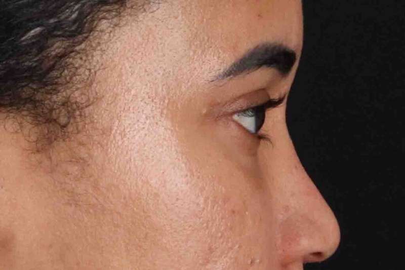 Blepharoplasty (Eyelid Surgery) Before & After Patient #4404