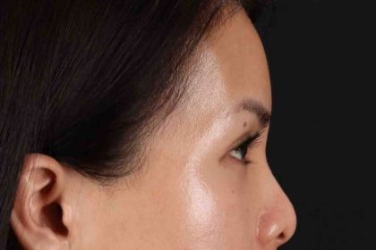 Blepharoplasty (Eyelid Surgery) Before & After Patient #4415