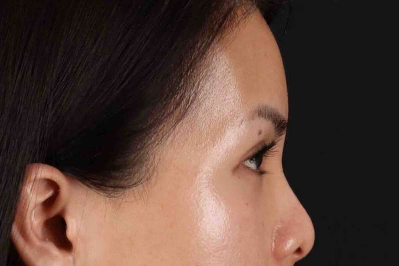 Blepharoplasty (Eyelid Surgery) Before & After Patient #4415