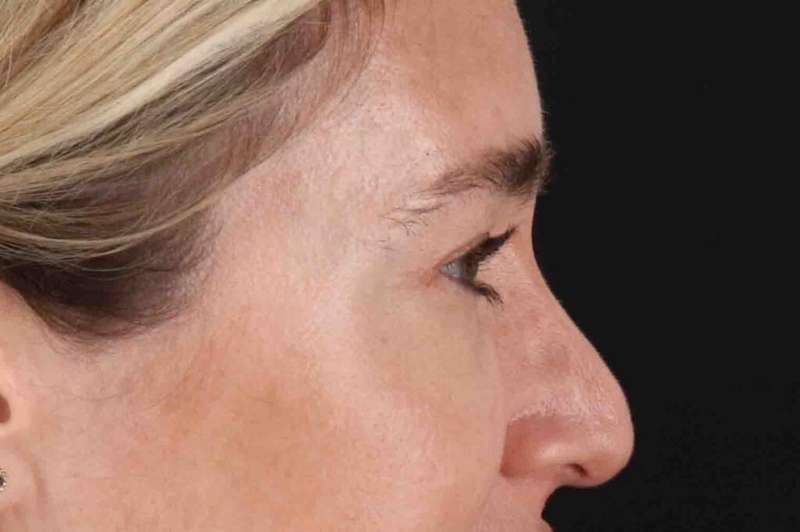 Blepharoplasty (Eyelid Surgery) Before & After Patient #4437