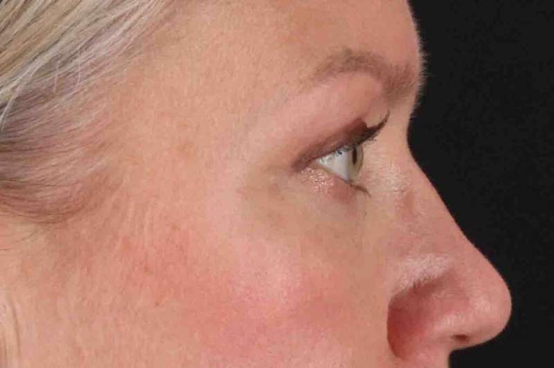 Blepharoplasty (Eyelid Surgery) Before & After Patient #4448