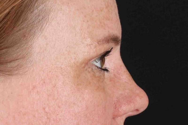 Blepharoplasty (Eyelid Surgery) Before & After Patient #4459