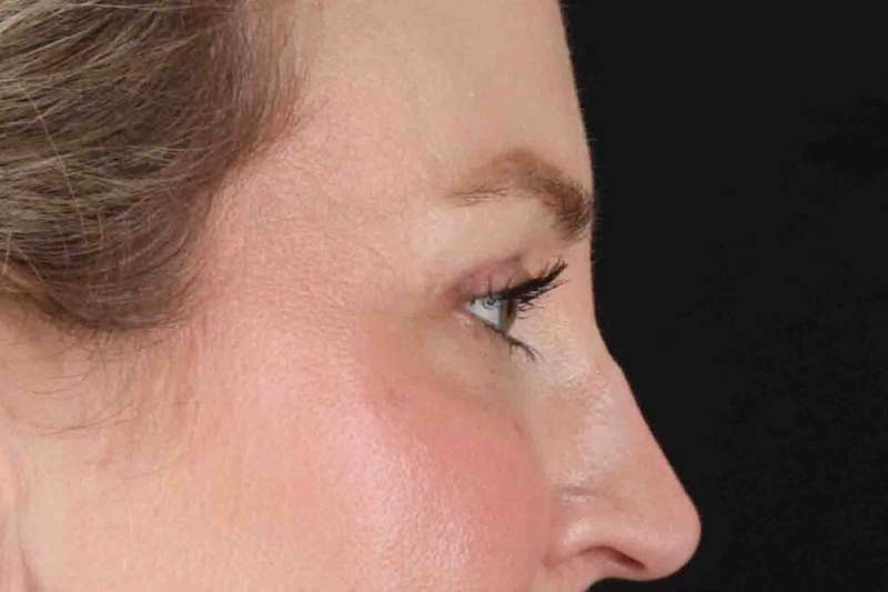 Blepharoplasty (Eyelid Surgery) Before & After Patient #4470