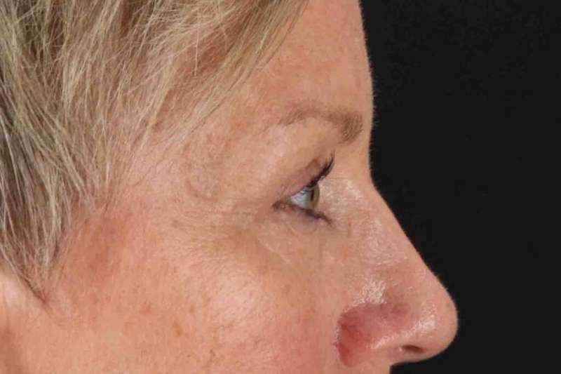 Blepharoplasty (Eyelid Surgery) Before & After Patient #4492